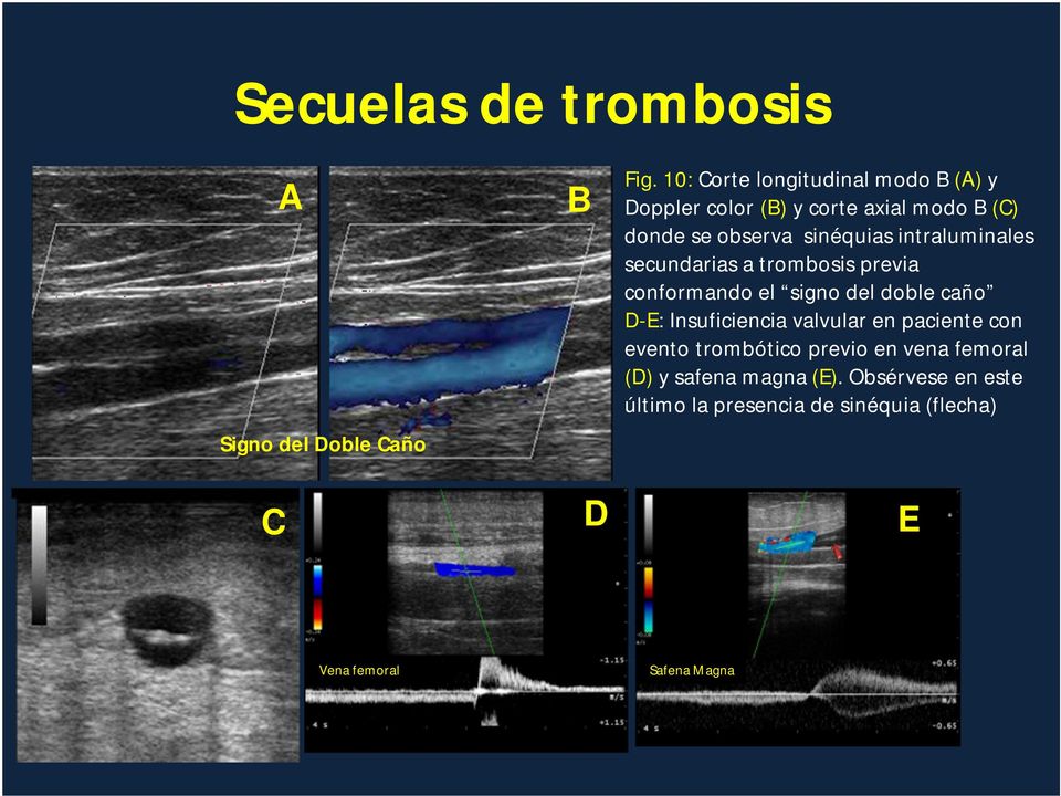 intraluminales secundarias a trombosis previa conformando el signo del doble caño D-E: Insuficiencia valvular