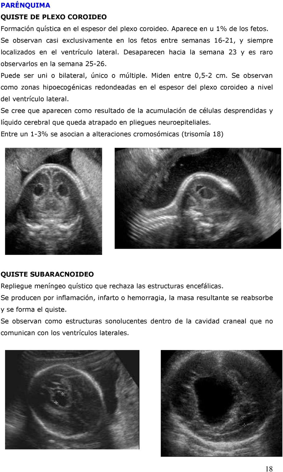 Puede ser uni o bilateral, único o múltiple. Miden entre 0,5-2 cm. Se observan como zonas hipoecogénicas redondeadas en el espesor del plexo coroideo a nivel del ventrículo lateral.