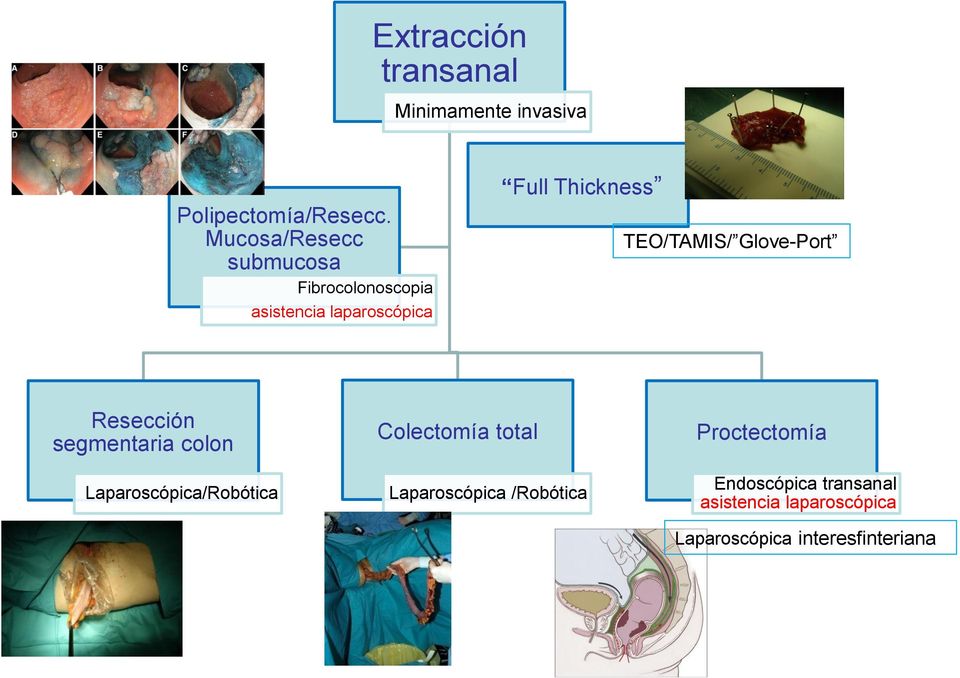 TEO/TAMIS/ Glove-Port Resección segmentaria colon Laparoscópica/Robótica Colectomía
