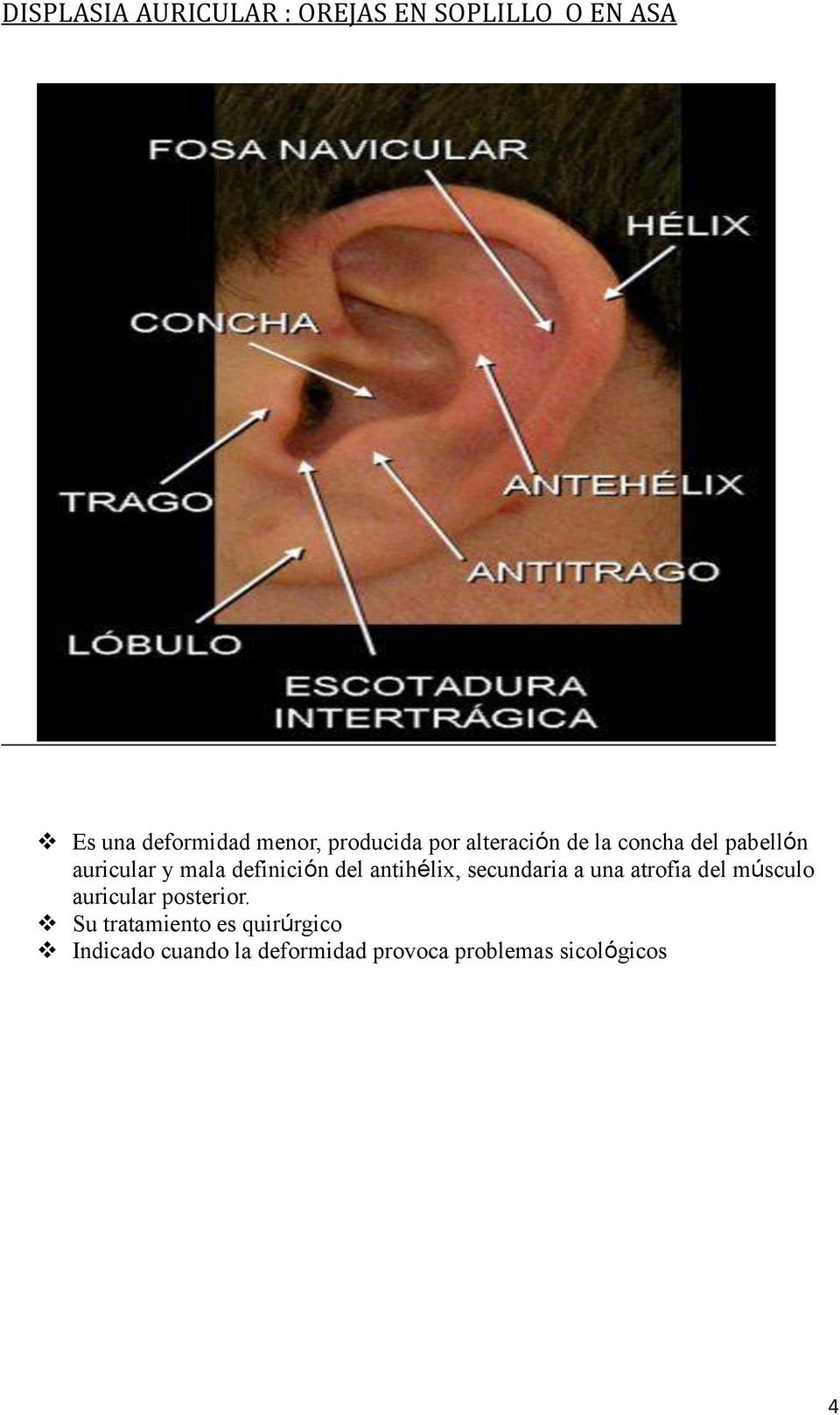del antihélix, secundaria a una atrofia del músculo auricular posterior.
