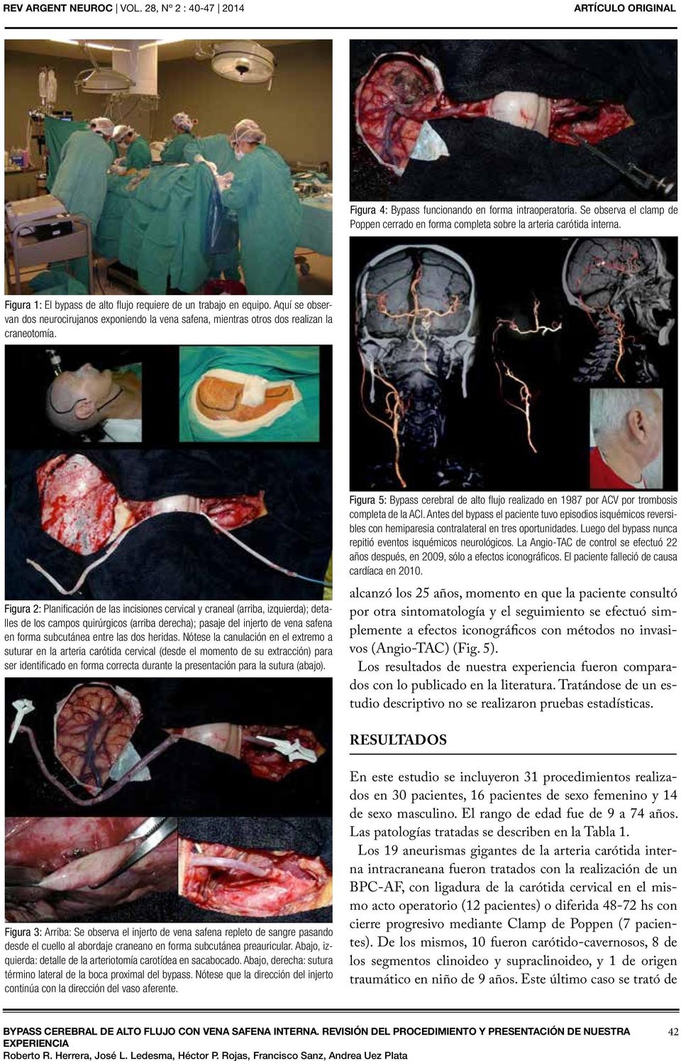 Figura 2: Planificación de las incisiones cervical y craneal (arriba, izquierda); detalles de los campos quirúrgicos (arriba derecha); pasaje del injerto de vena safena en forma subcutánea entre las
