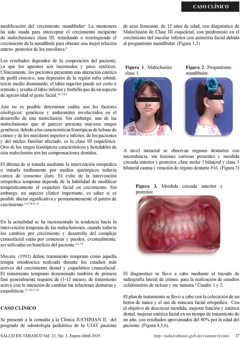 4 de sexo femenino, de 12 años de edad, con diagnóstico de Maloclusión de Clase III esqueletal, con predominio en el crecimiento del maxilar inferior con asimetría facial debida al prognatismo
