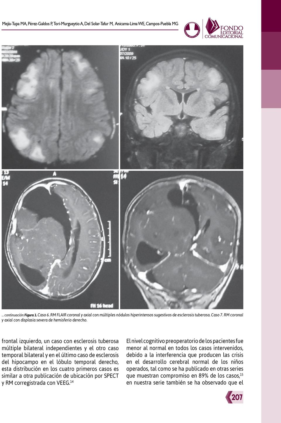 frontal izquierdo, un caso con esclerosis tuberosa múltiple bilateral independientes y el otro caso temporal bilateral y en el último caso de esclerosis del hipocampo en el lóbulo temporal derecho,