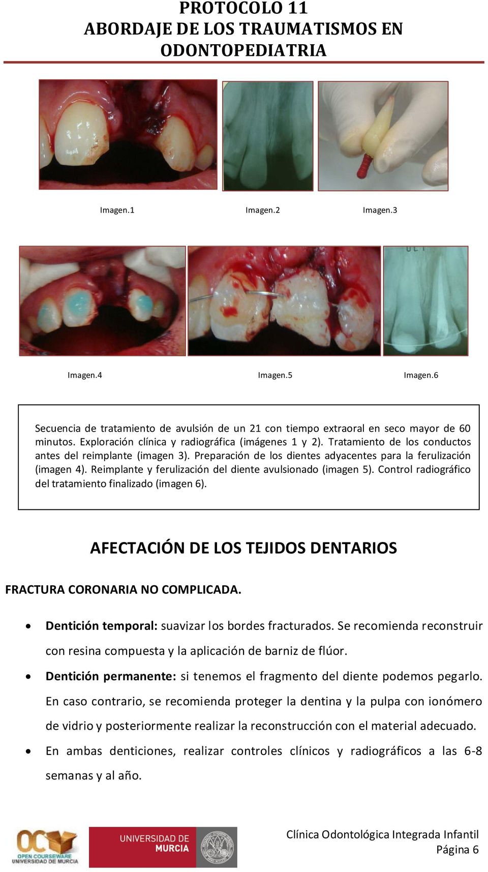 Reimplante y ferulización del diente avulsionado (imagen 5). Control radiográfico del tratamiento finalizado (imagen 6). AFECTACIÓN DE LOS TEJIDOS DENTARIOS FRACTURA CORONARIA NO COMPLICADA.