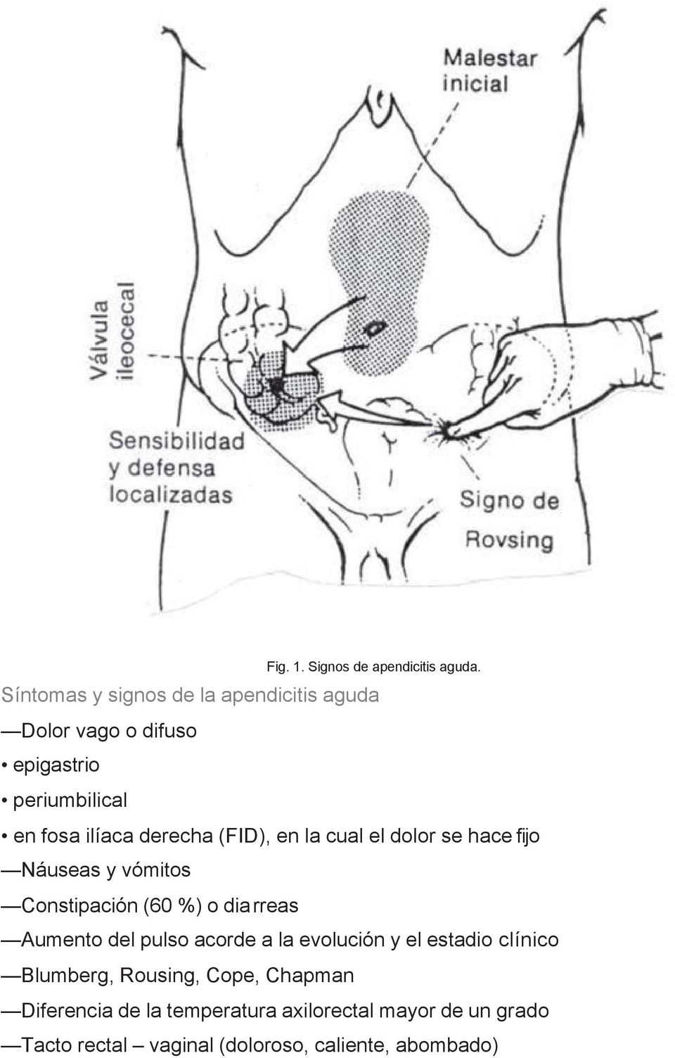 (FID), en la cual el dolor se hace fijo Náuseas y vómitos Constipación (60 %) o diarreas Aumento del pulso