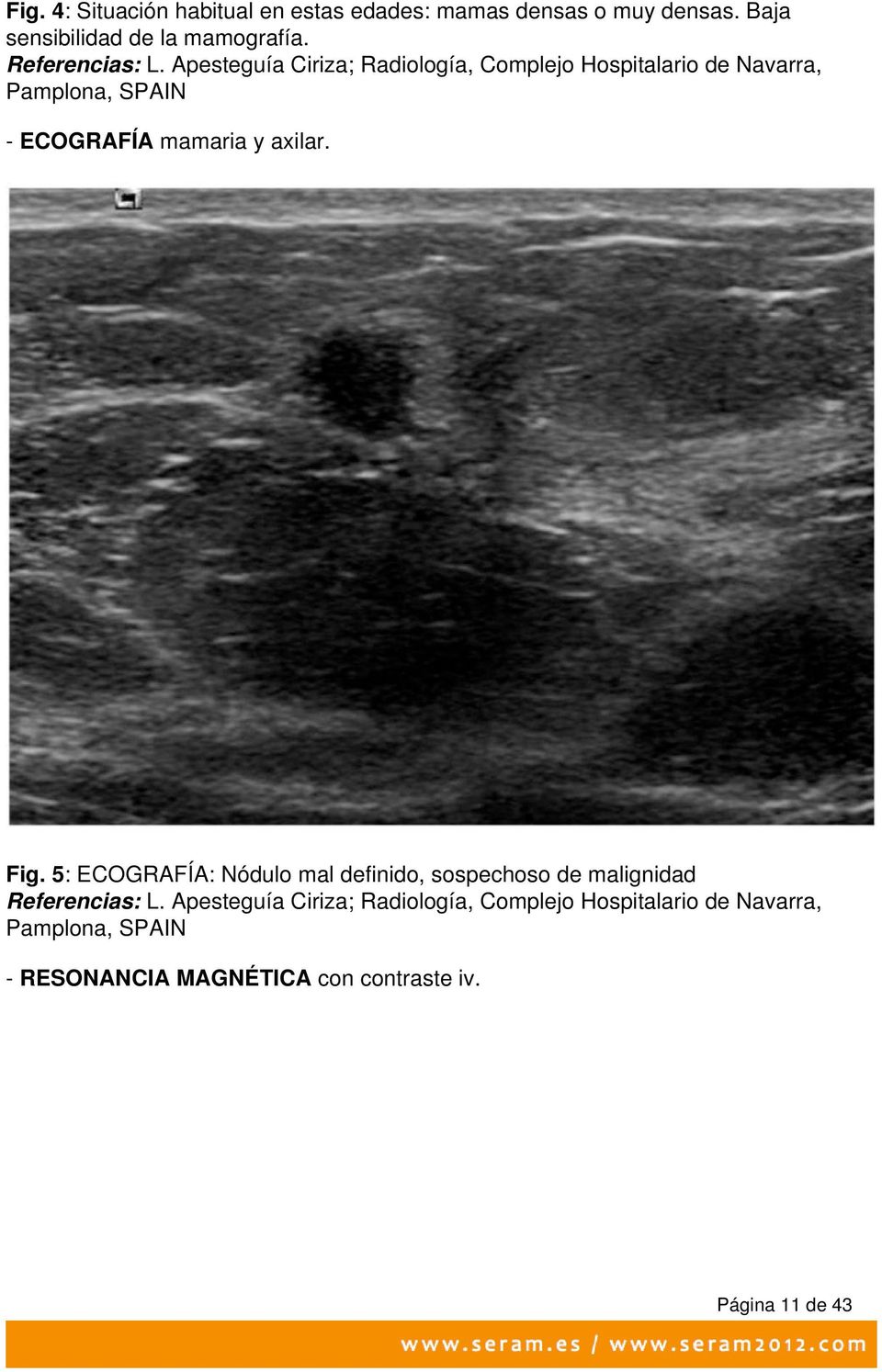 Apesteguía Ciriza; Radiología, Complejo Hospitalario de Navarra, Pamplona, SPAIN - ECOGRAFÍA mamaria y axilar.