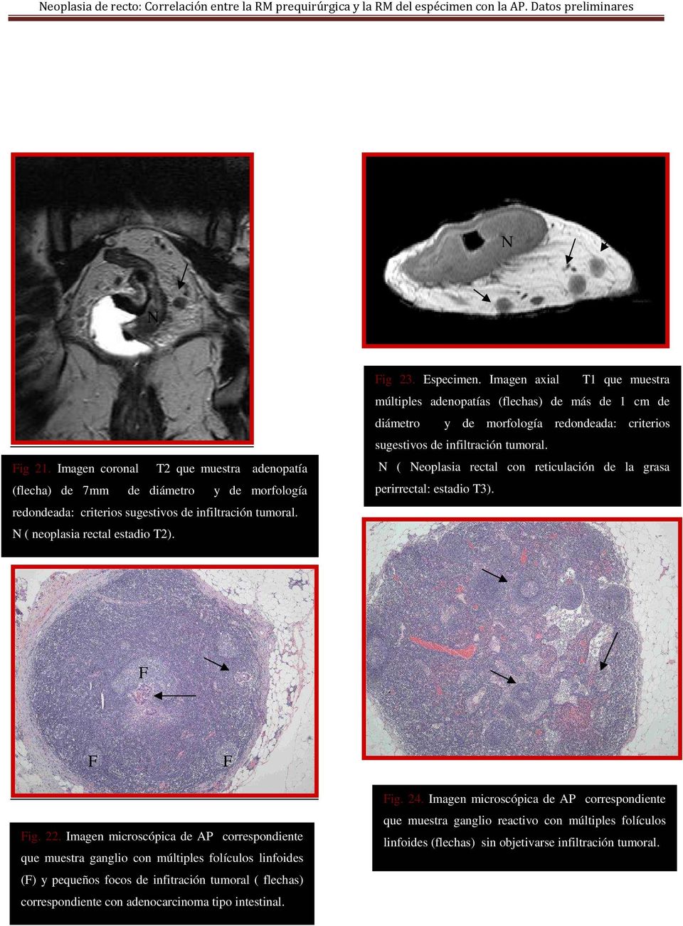 N ( Neoplasia rectal con reticulación de la grasa perirrectal: estadio T3). F F F Fig. 22.