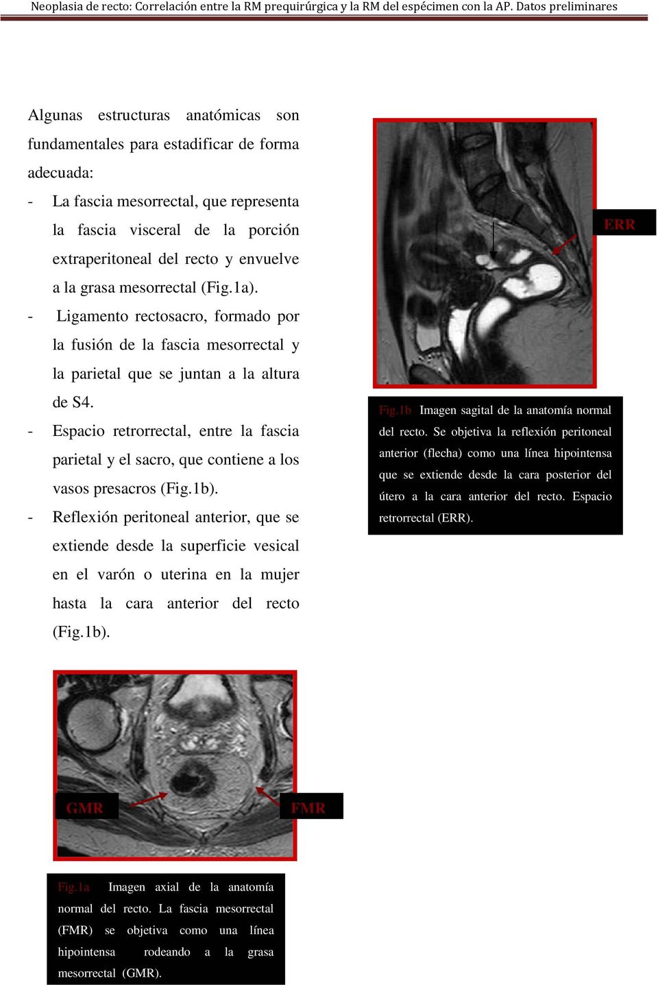 - Espacio retrorrectal, entre la fascia parietal y el sacro, que contiene a los vasos presacros (Fig.1b).