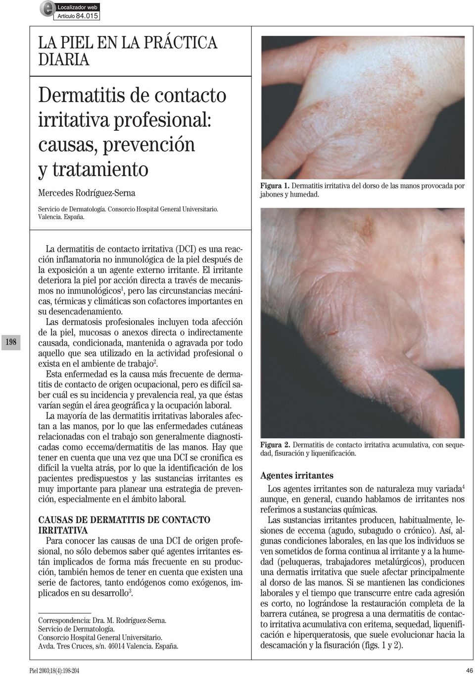 198 La dermatitis de contacto irritativa (DCI) es una reacción inflamatoria no inmunológica de la piel después de la exposición a un agente externo irritante.