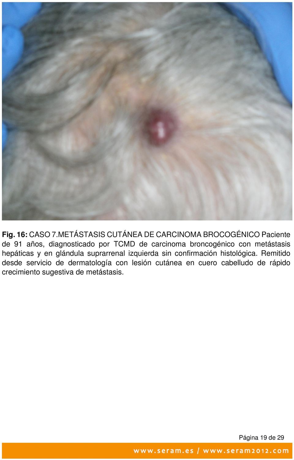 carcinoma broncogénico con metástasis hepáticas y en glándula suprarrenal izquierda sin
