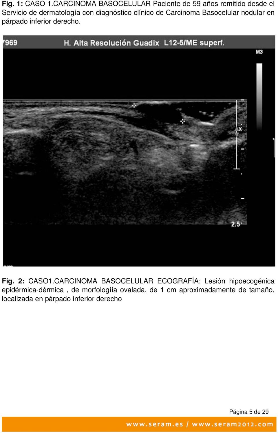 diagnóstico clínico de Carcinoma Basocelular nodular en párpado inferior derecho. Fig. 2: CASO1.