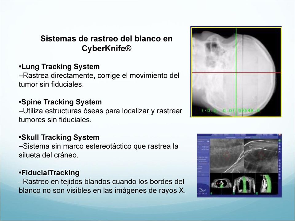 Spine Tracking System Utiliza estructuras óseas para localizar y rastrear tumores sin fiduciales.