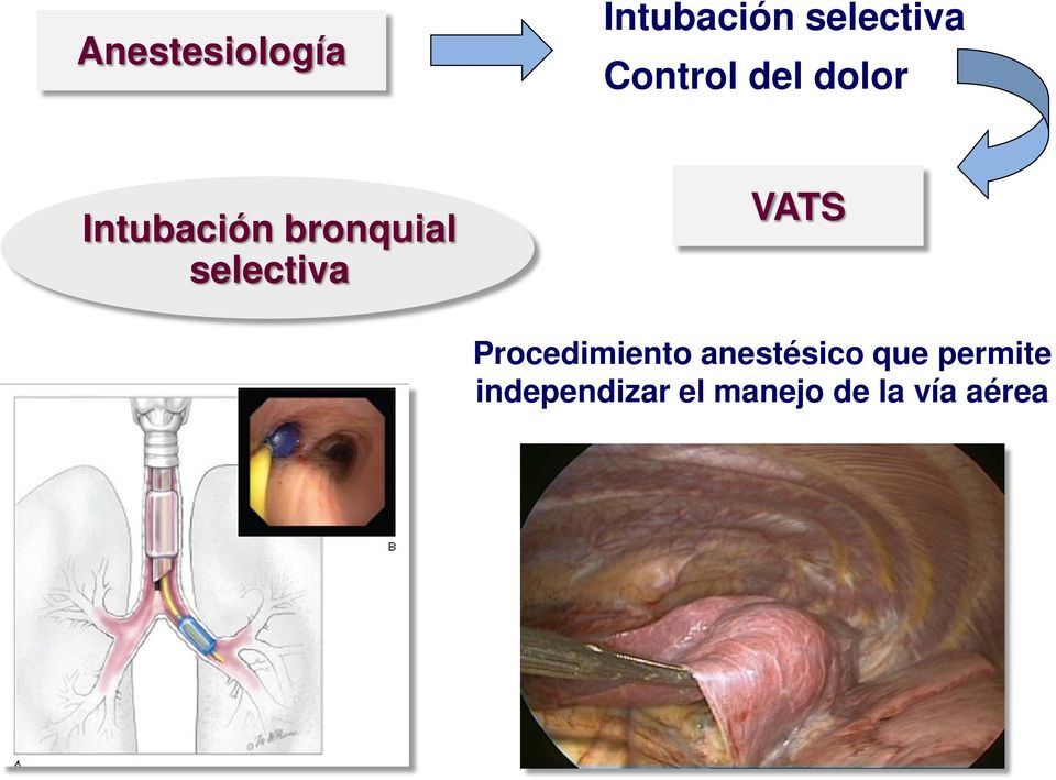 selectiva VATS Procedimiento anestésico