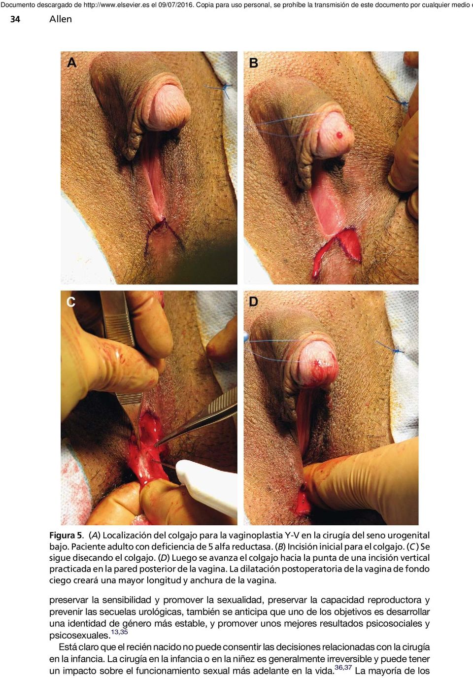 La dilatación postoperatoria de la vagina de fondo ciego creará una mayor longitud y anchura de la vagina.