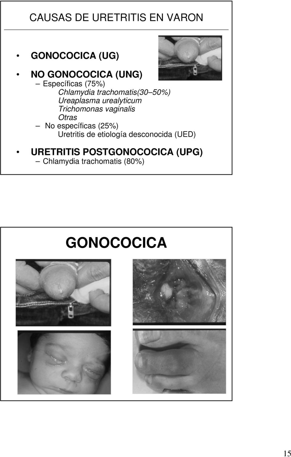 Trichomonas vaginalis Otras No específicas (25%) Uretritis de etiología