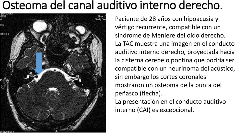 La TAC muestra una imagen en el conducto auditivo interno derecho, proyectada hacia la cisterna cerebelo pontina que