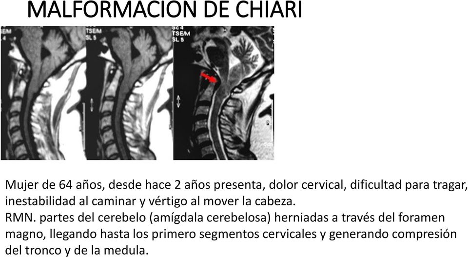 partes del cerebelo (amígdala cerebelosa) herniadas a través del foramen magno,