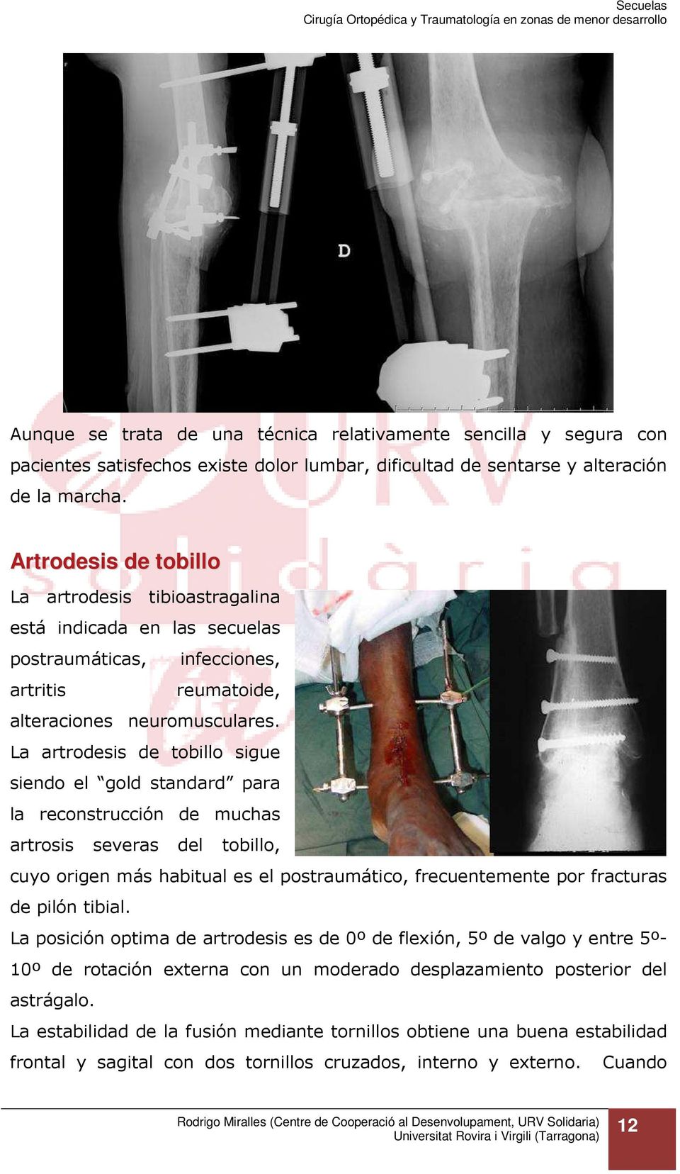 La artrodesis de tobillo sigue siendo el gold standard para la reconstrucción de muchas artrosis severas del tobillo, cuyo origen más habitual es el postraumático, frecuentemente por fracturas de