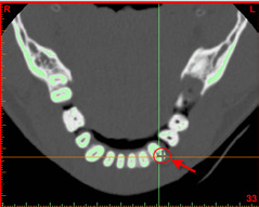 Segmentación avanzada: dientes SIMPLANT Pro En esta sección explicaremos como puede realizar una segmentación independiente