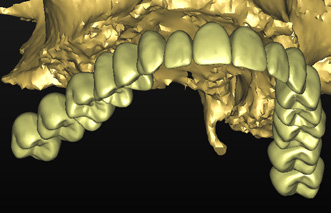 Cuando tengamos una mandíbula totalmente edéntula podemos crear una dentadura completa mediante el asistente para dientes virtuales. Primero seleccione el diente externo del puente (22).