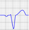 Derivaciones posteriores - Monitorizacion del paciente - Ecocardiograma IAM posterior aislado - Depresion del ST 0,5 mm en V1-V3.