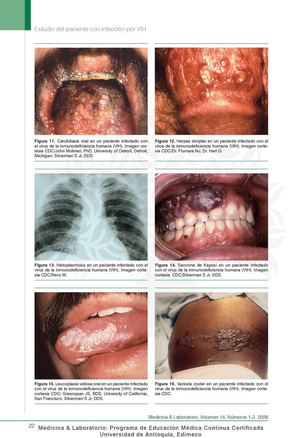 Herpes simplex en un paciente infectado con el virus de la inmunodeficiencia humana (VIH). Imagen cortesía CDC/Dr. Flumara NJ, Dr. Hart G. Figura 13.