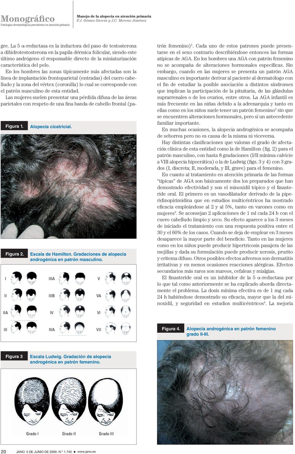 En los hombres las zonas típicamente más afectadas son la línea de implantación frontoparietal (entradas) del cuero cabelludo y la zona del vértex (coronilla) lo cual se corresponde con el patrón