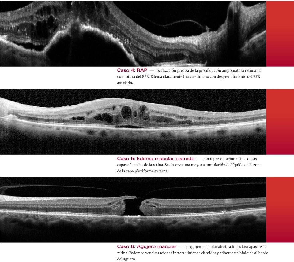 Caso 5: Edema macular cistoide con representación nítida de las capas afectadas de la retina.