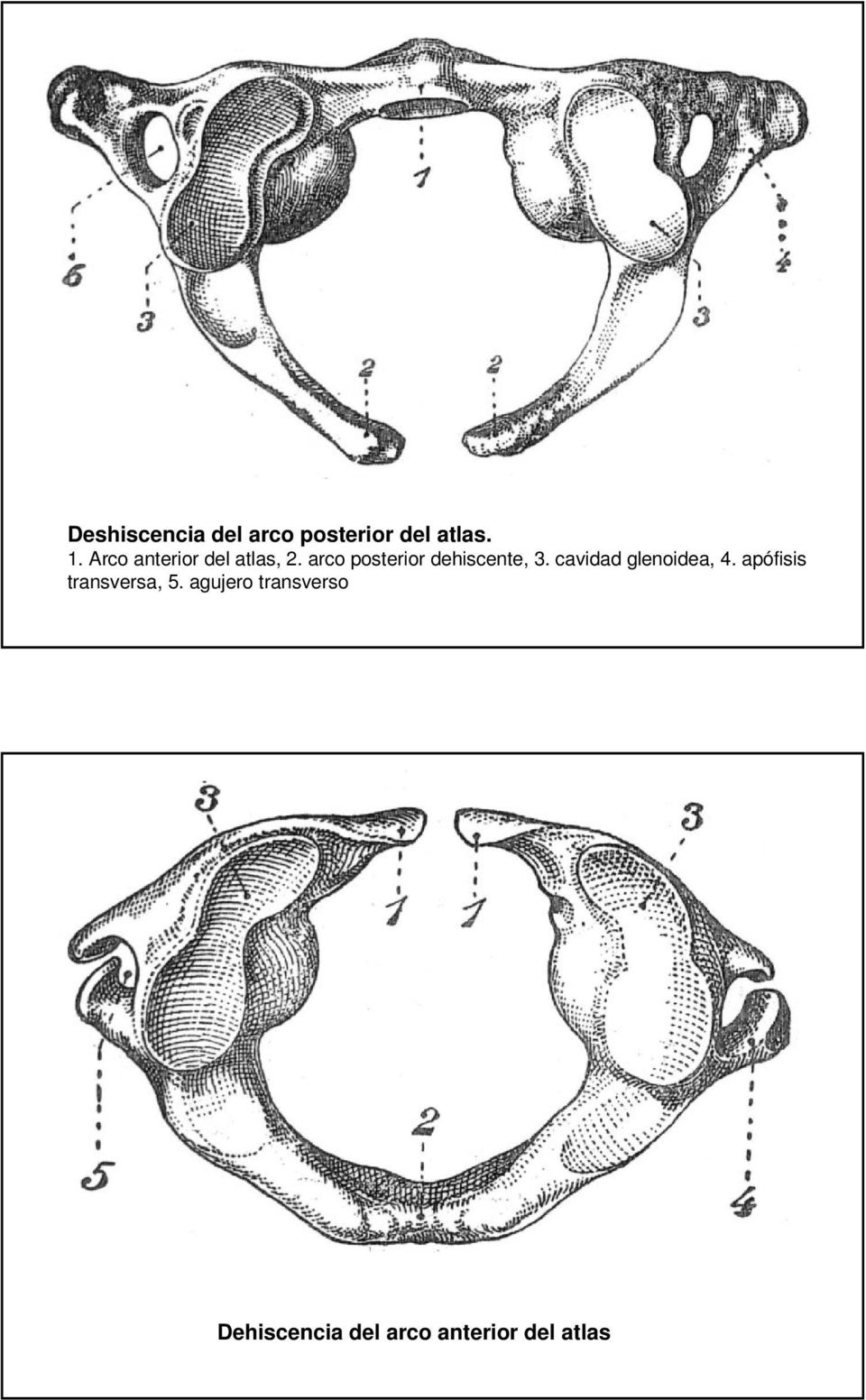 arco posterior dehiscente, 3. cavidad glenoidea, 4.