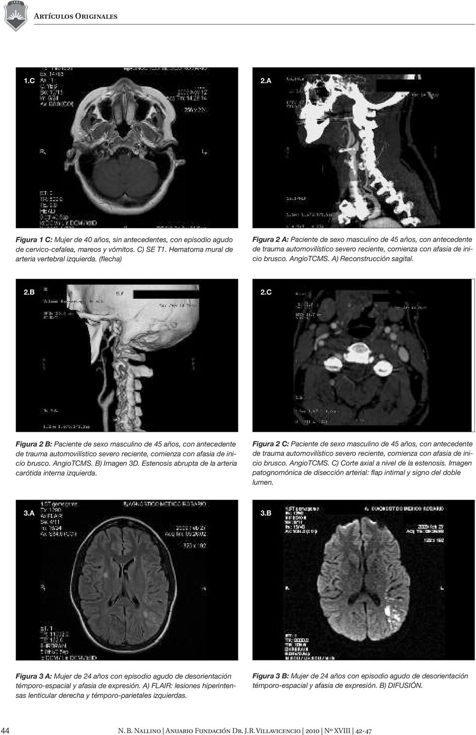 C Figura 2 B: Paciente de sexo masculino de 45 años, con antecedente de trauma automovilístico severo reciente, comienza con afasia de inicio brusco. AngioTCMS. B) Imagen 3D.