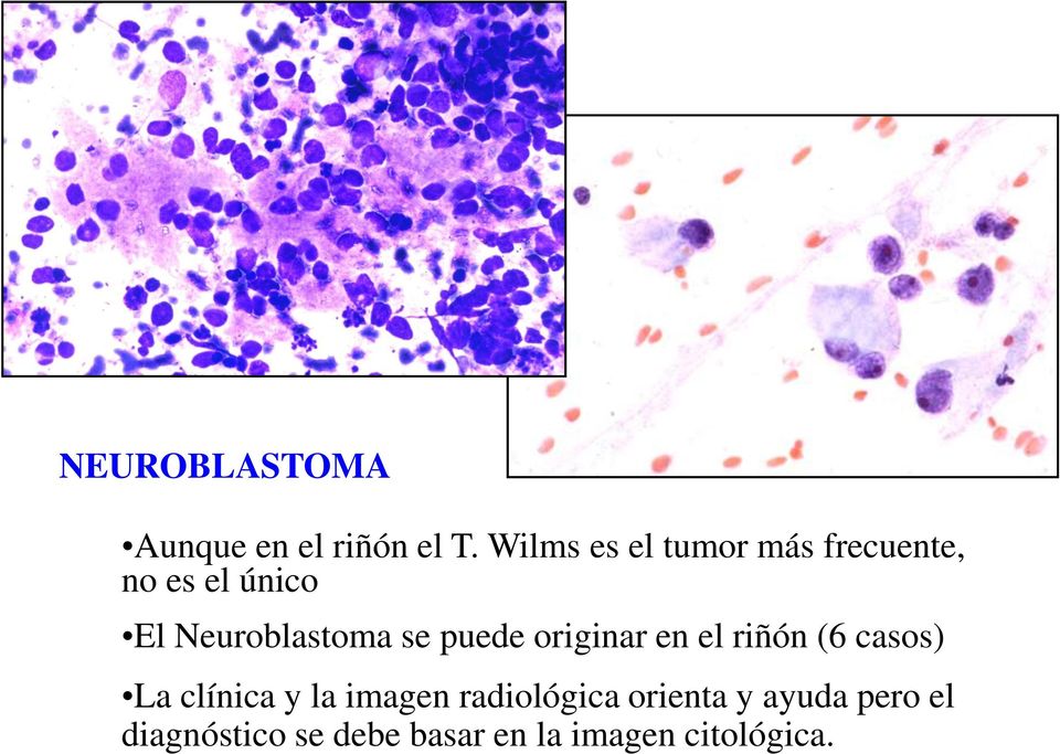 Neuroblastoma se puede originar en el riñón (6 casos) La
