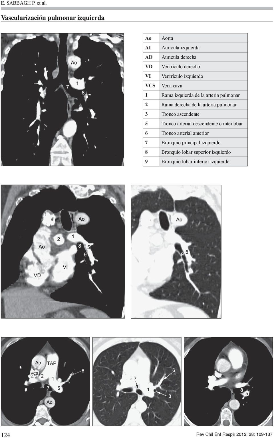 Ventrículo izquierdo VCS Vena cava 1 Rama izquierda de la arteria pulmonar 2 Rama derecha de la arteria