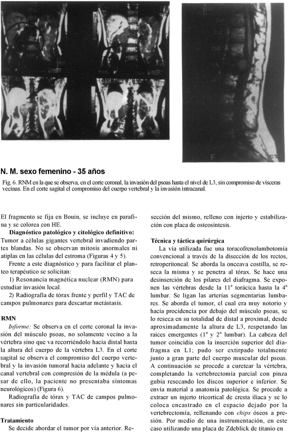 Diagnóstico patológico y citológico definitivo: Tumor a células gigantes vertebral invadiendo partes blandas. No se observan mitosis anormales ni atiplas en las células del estroma (Figuras 4 y 5).
