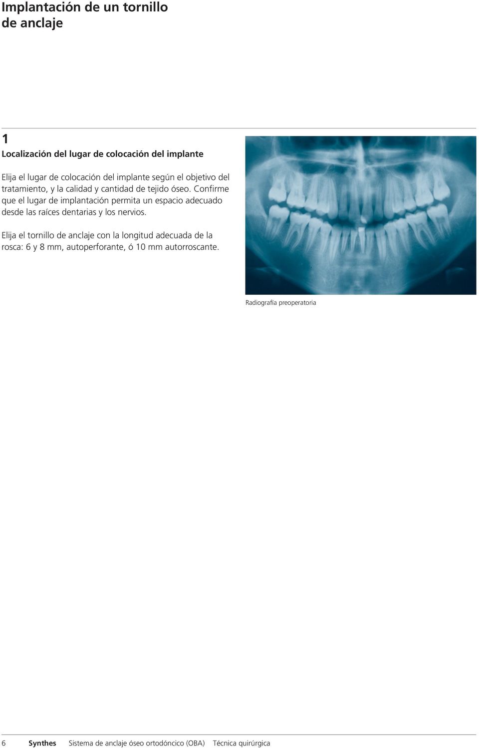 Confirme que el lugar de implantación permita un espacio adecuado desde las raíces dentarias y los nervios.