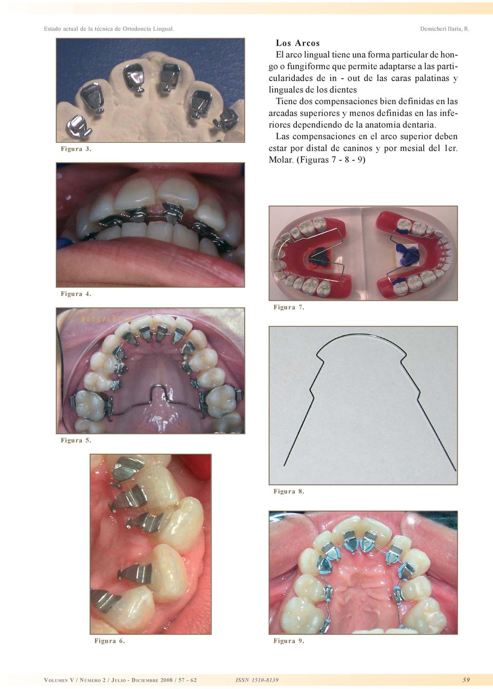 palatinas y linguales de los dientes Tiene dos compensaciones bien definidas en las arcadas superiores y menos definidas en las inferiores