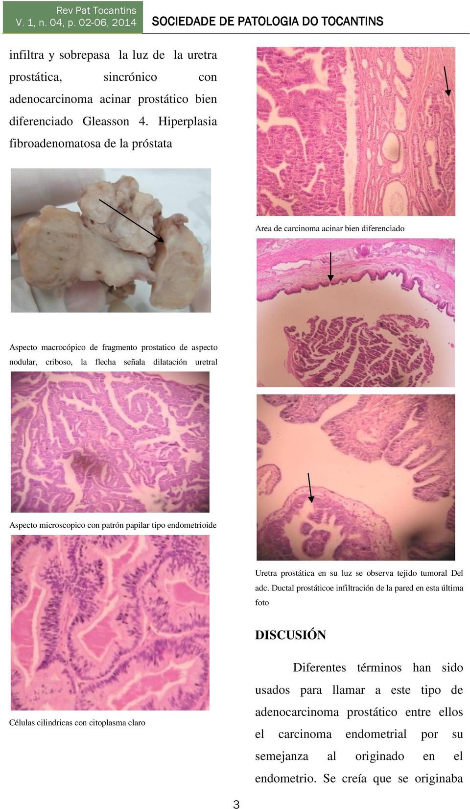 uretral Aspecto microscopico con patrón papilar tipo endometrioide Uretra prostática en su luz se observa tejido tumoral Del adc.