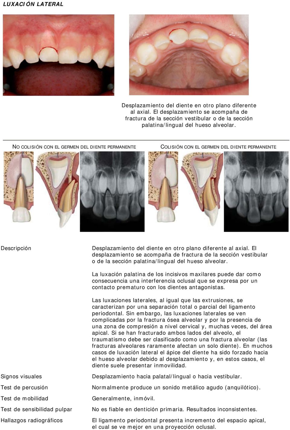 El desplazamiento se acompaña de fractura de la sección vestibular o de la sección palatina/lingual del hueso alveolar.