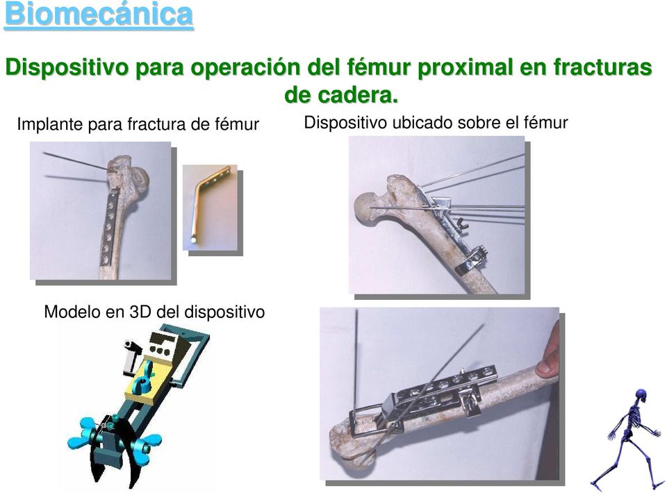 Implante para fractura de fémur Dispositivo