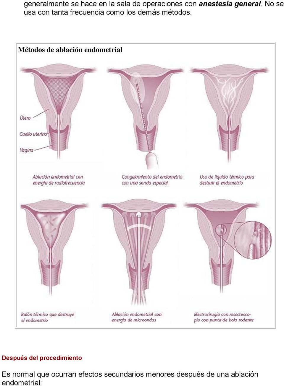 Métodos de ablación endometrial Después del procedimiento Es normal