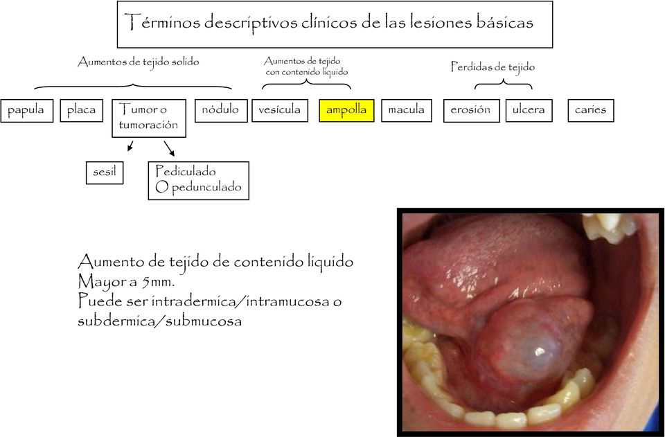 vesícula ampolla macula erosión ulcera caries sesil Pediculado O pedunculado Aumento de
