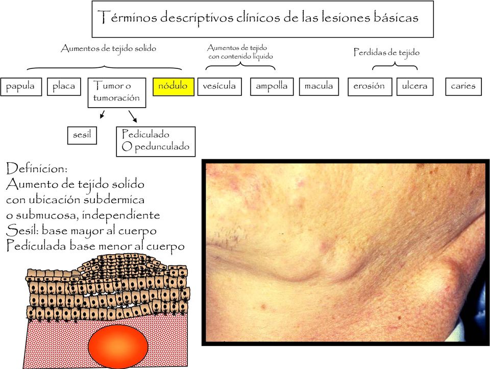 macula erosión ulcera caries sesil Pediculado O pedunculado Definicion: Aumento de tejido solido con