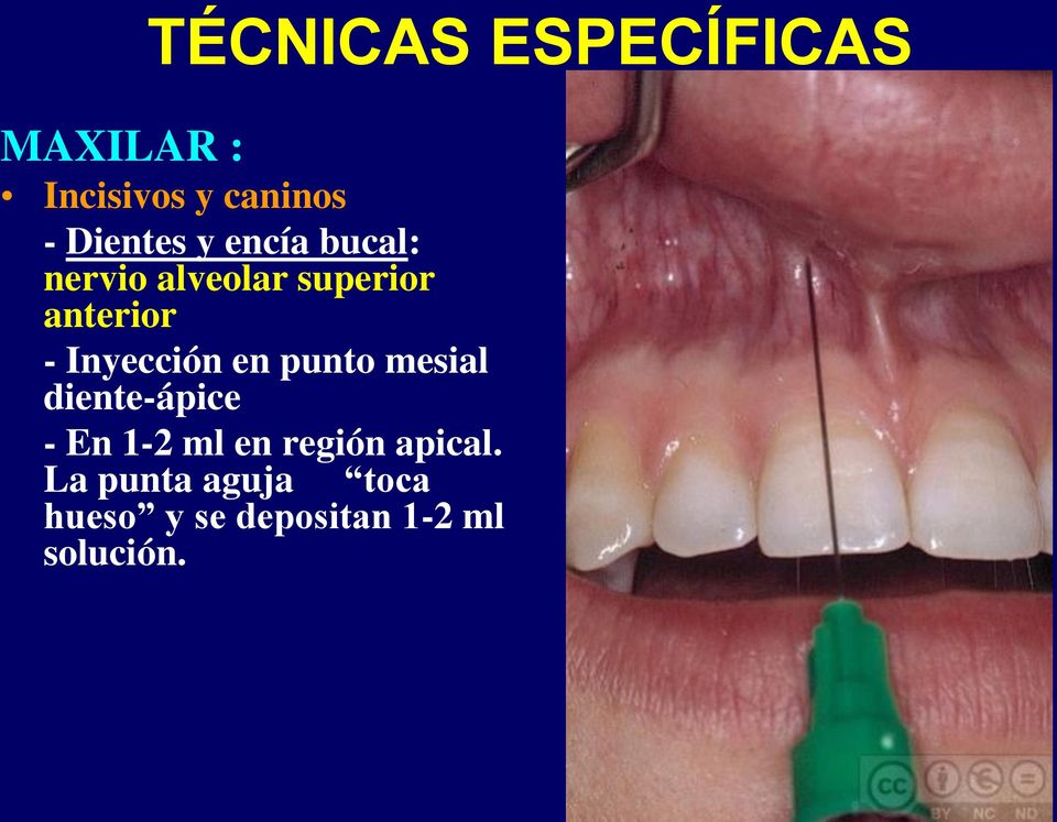 Inyección en punto mesial diente-ápice - En 1-2 ml en