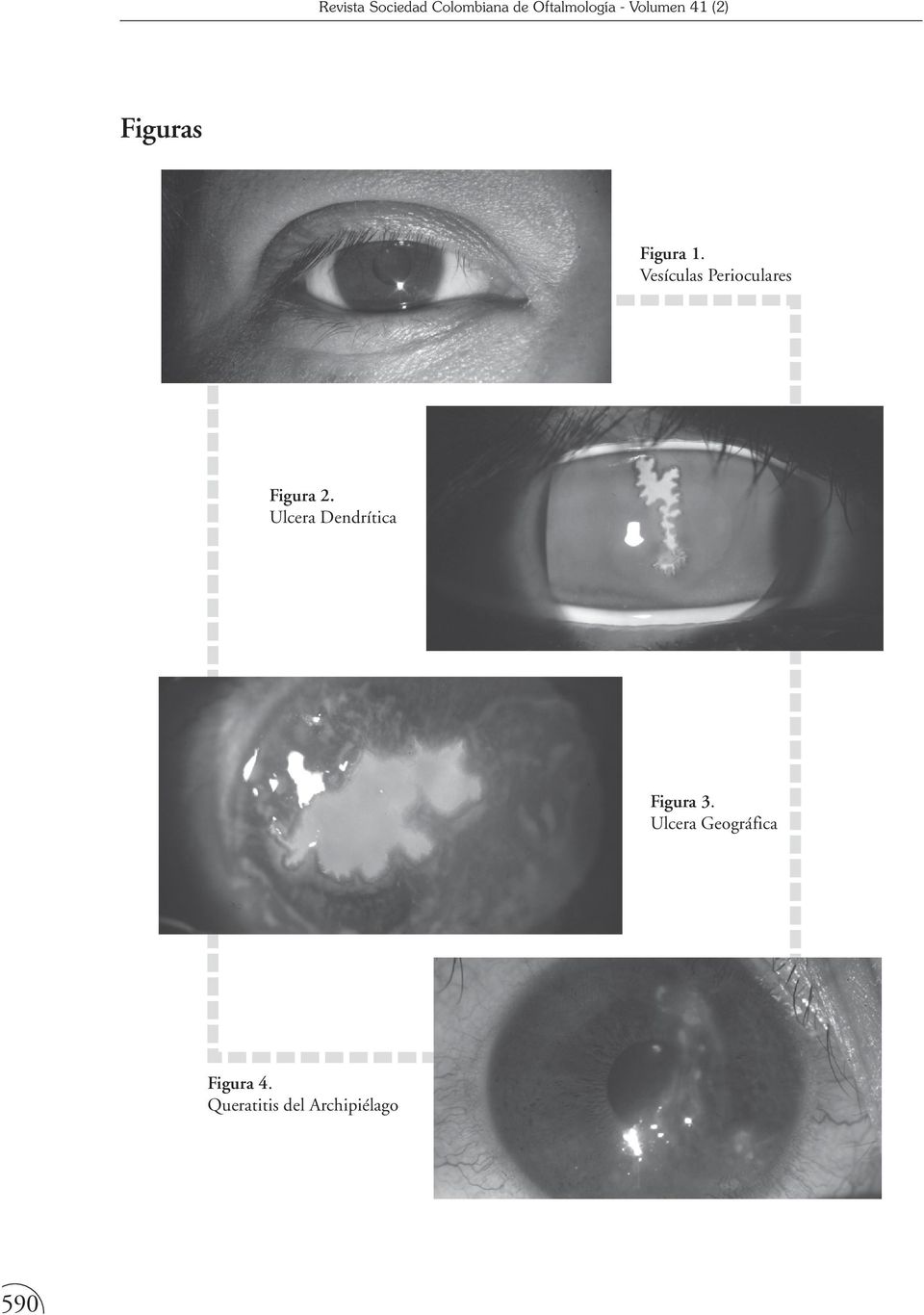 Ulcera Dendrítica Figura 3.