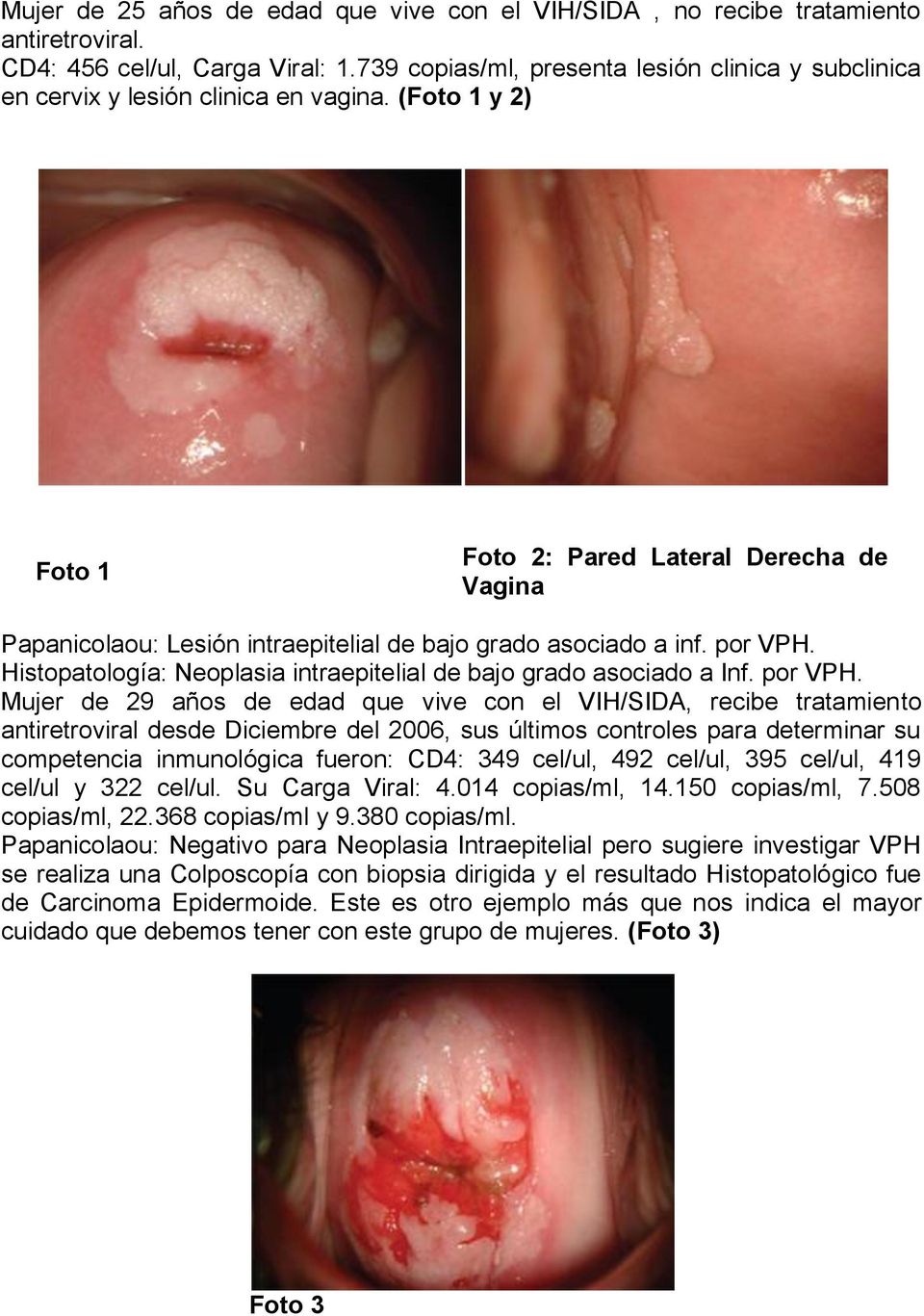(Foto 1 y 2) Foto 1 Foto 2: Pared Lateral Derecha de Vagina Papanicolaou: Lesión intraepitelial de bajo grado asociado a inf. por VPH.