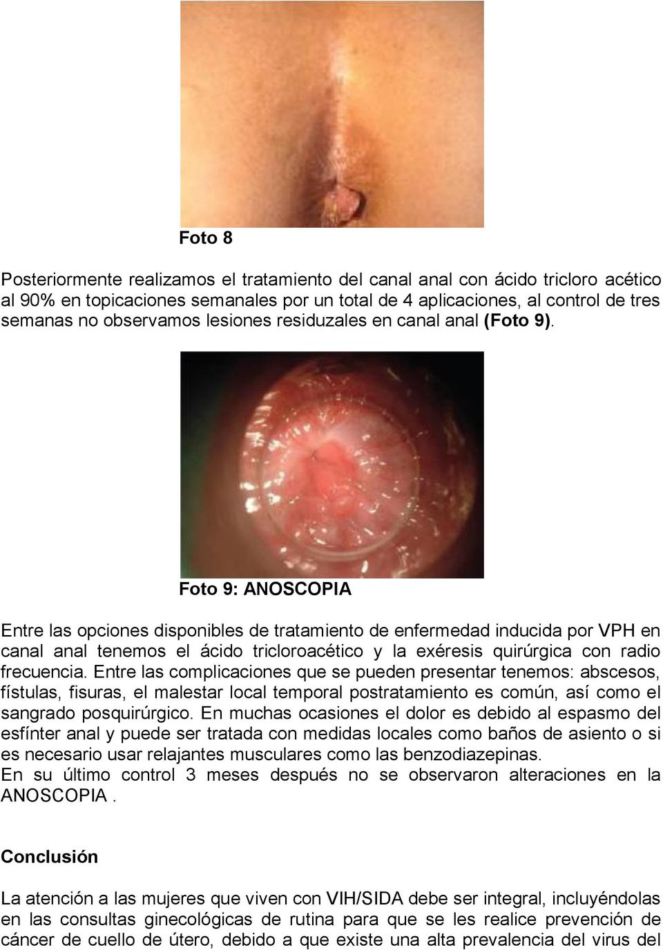 Foto 9: ANOSCOPIA Entre las opciones disponibles de tratamiento de enfermedad inducida por VPH en canal anal tenemos el ácido tricloroacético y la exéresis quirúrgica con radio frecuencia.