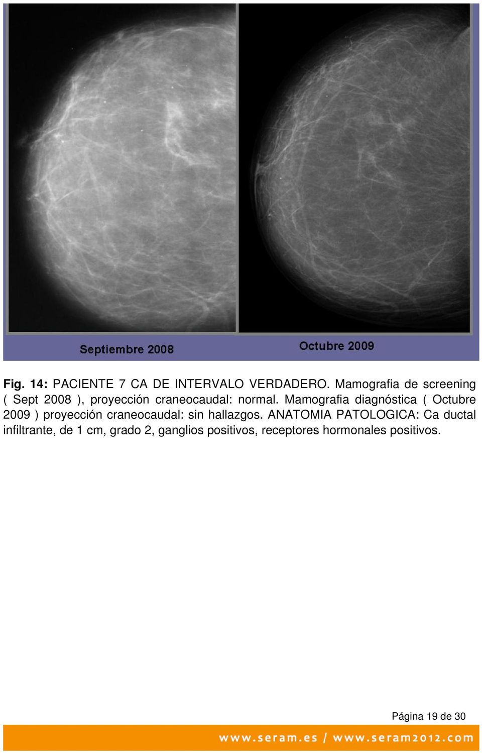 Mamografia diagnóstica ( Octubre 2009 ) proyección craneocaudal: sin hallazgos.