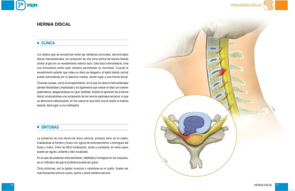 Cuando el revestimiento exterior que rodea un disco se desgarra, el tejido blando central puede sobresalirse por la abertura creada, dando lugar a una hernia discal.