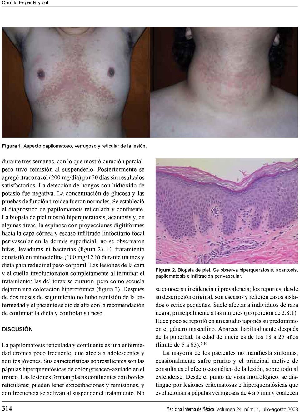 Papilomatosis piel histopatologia. Dermatosis Papuloma Nigra cancer endocrine therapies