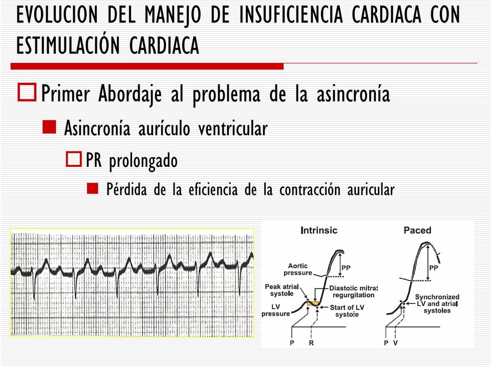 la asincronía Asincronía aurículo ventricular PR