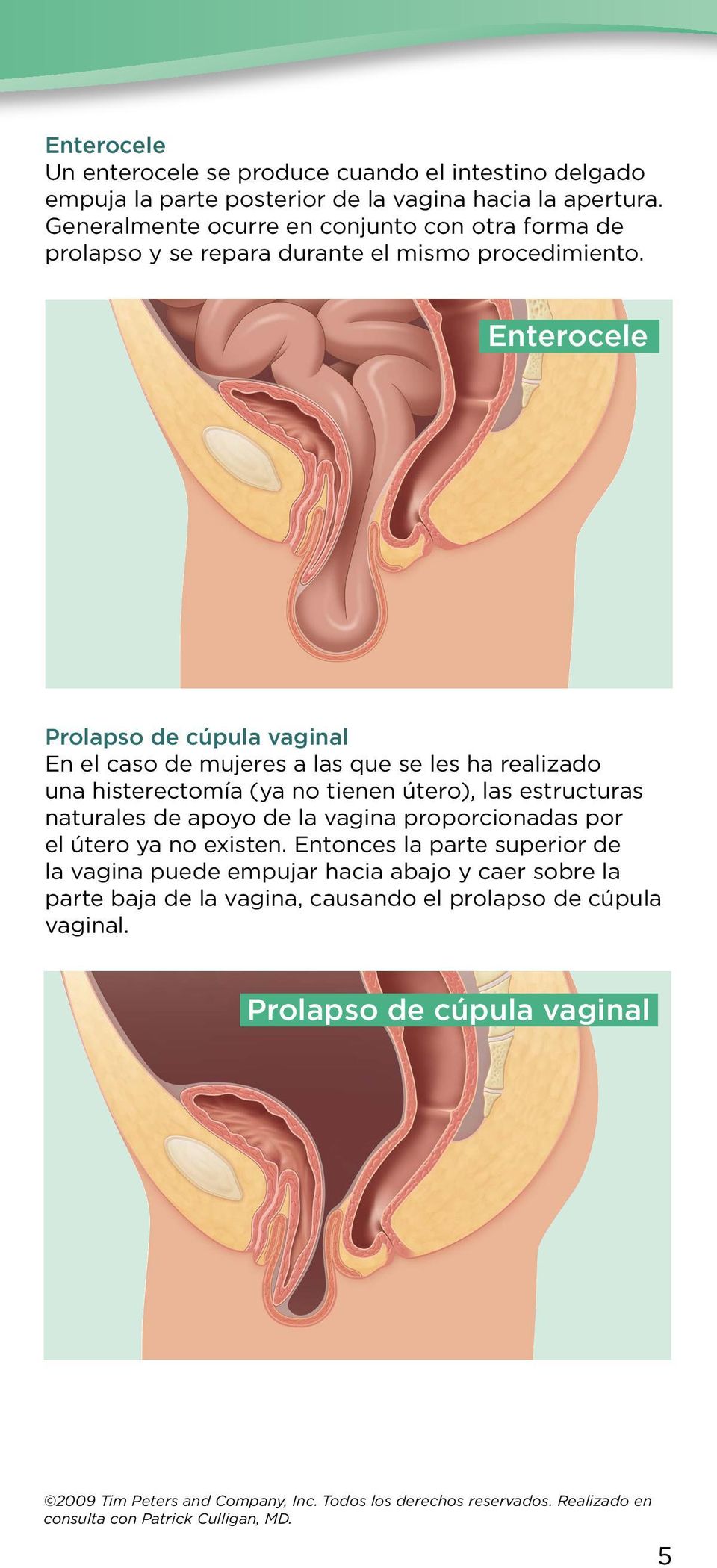 Enterocele Prolapso de cúpula vaginal En el caso de mujeres a las que se les ha realizado una histerectomía (ya no tienen útero), las estructuras naturales de apoyo de la vagina
